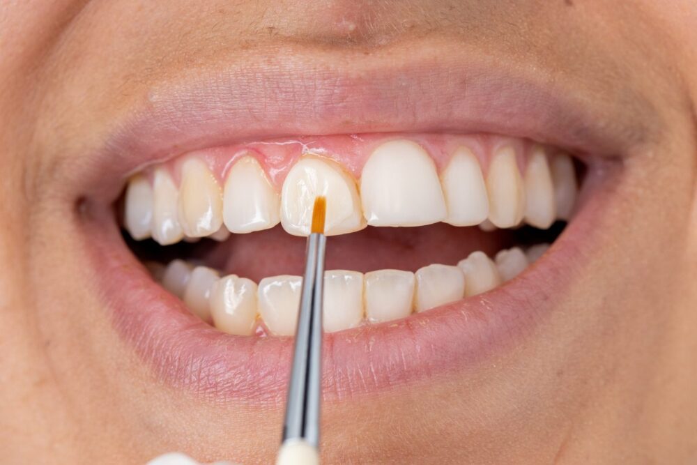 Bonding samsett efni